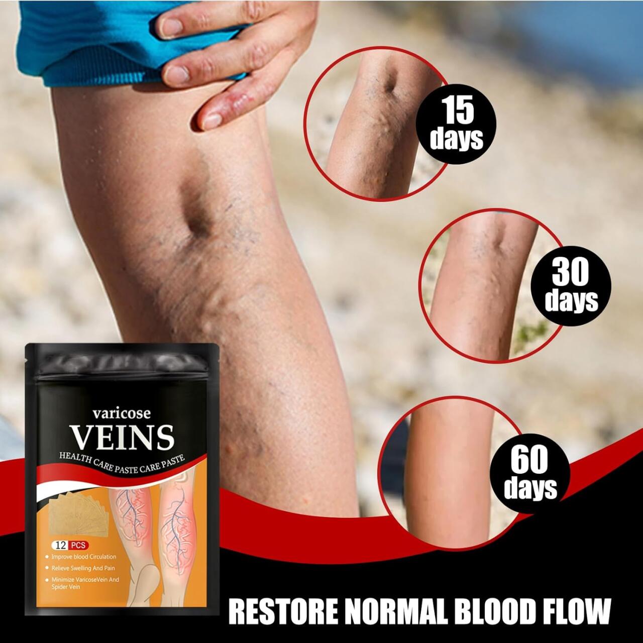 Varicose Veins