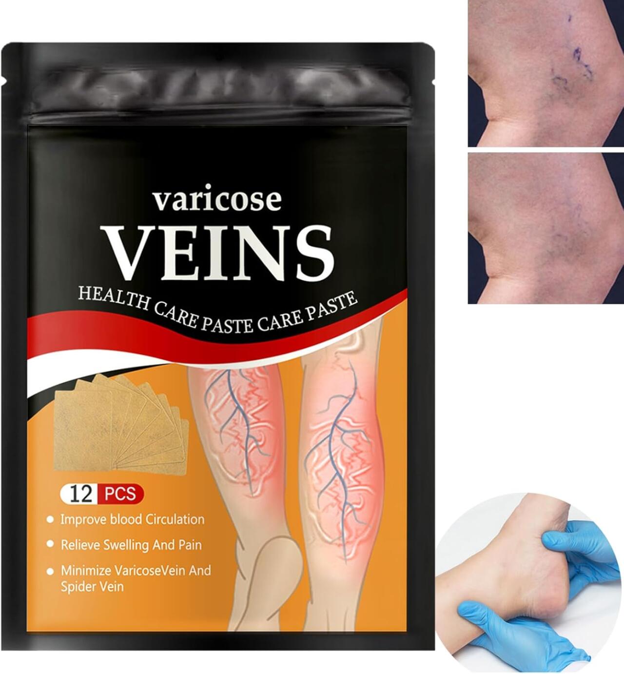 Varicose Veins