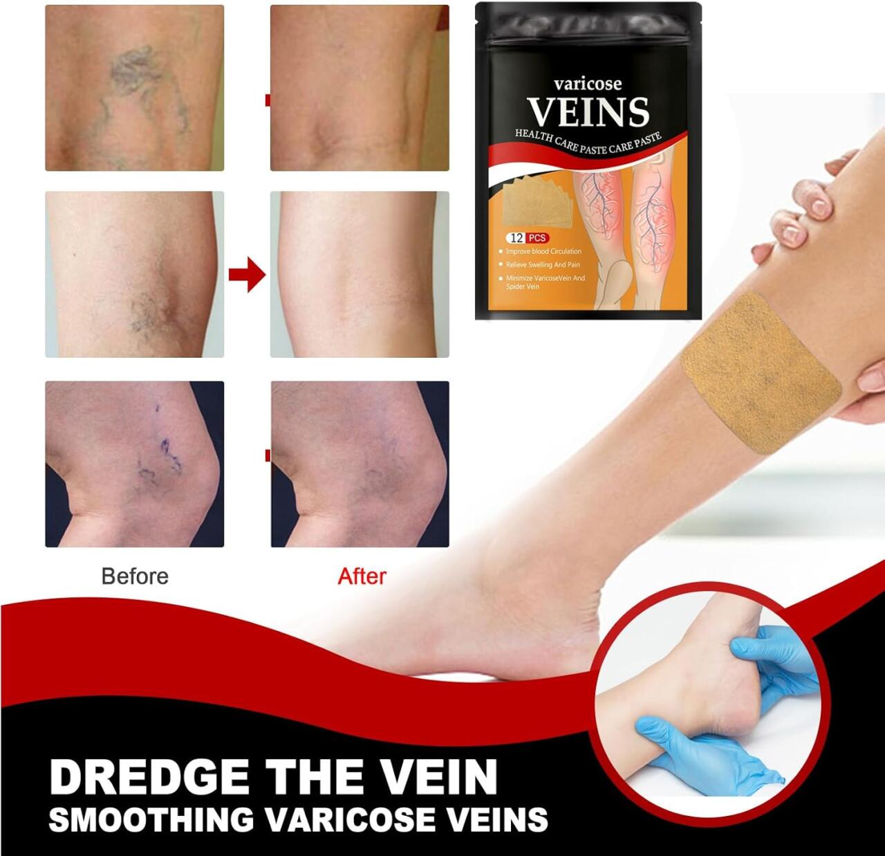 Varicose Veins